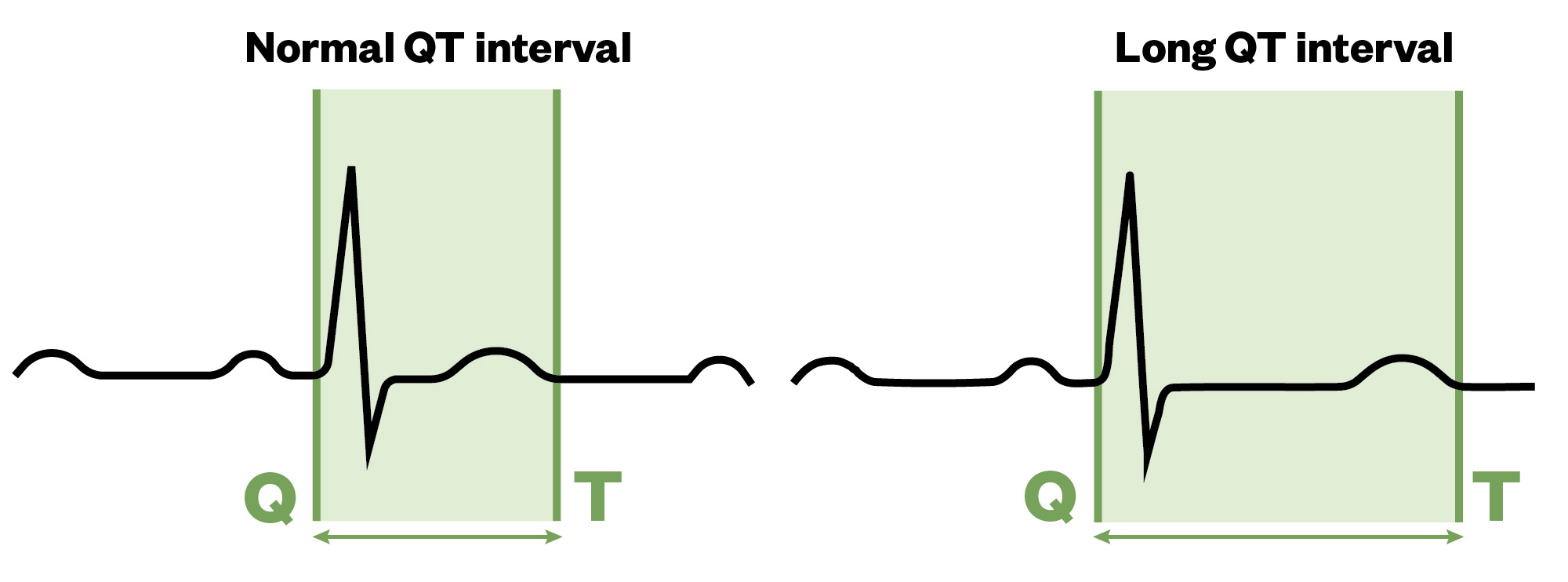 A simple diagram comparison between the ECG of a normal heart rhythm and someone with Long QT Syndrome