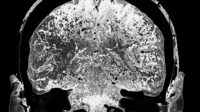 3D computed tomography (CT) scan of the bran of a patient who has had an ischaemic stroke or cerebrovascular accident (CVA) affecting the supplementary motor area (left). An ischaemic stroke is caused by a blockage or interruption of the blood supply to the brain. The lack of oxygen (hypoxia) damages the brain. Symptoms depend on the area affected.