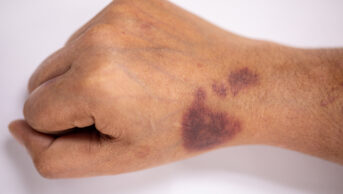 Hand showing haemophilia in hand