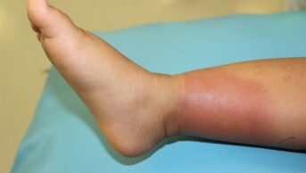 Bacterial skin infection on a child's right lower leg