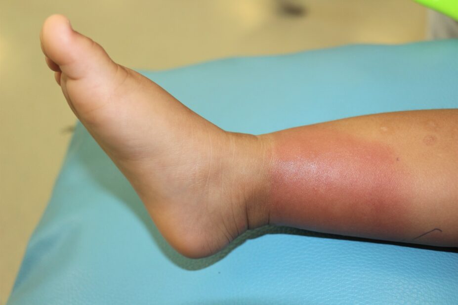 Bacterial skin infection on a child's right lower leg
