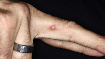 Rash on the hand of a male patient infected with mpox