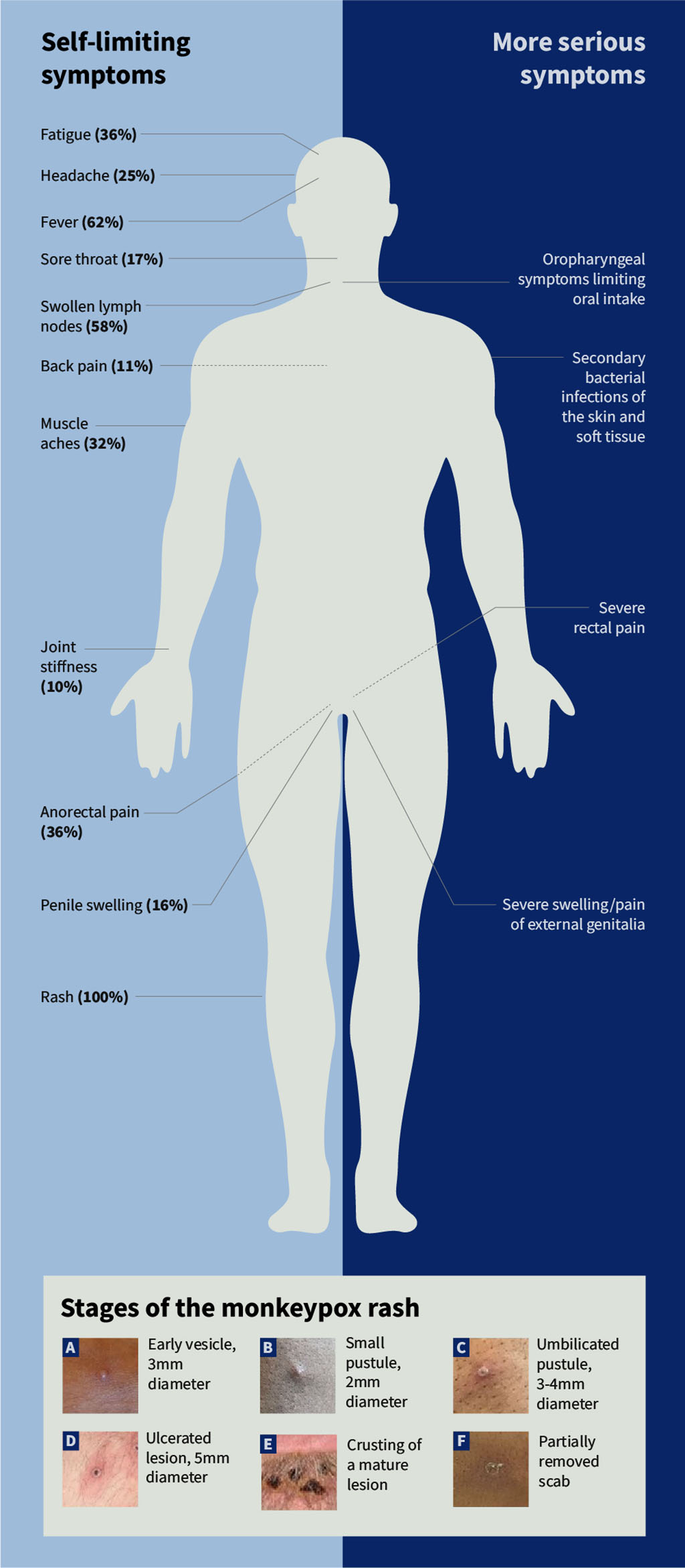 Diagram showing the symptoms of mpox