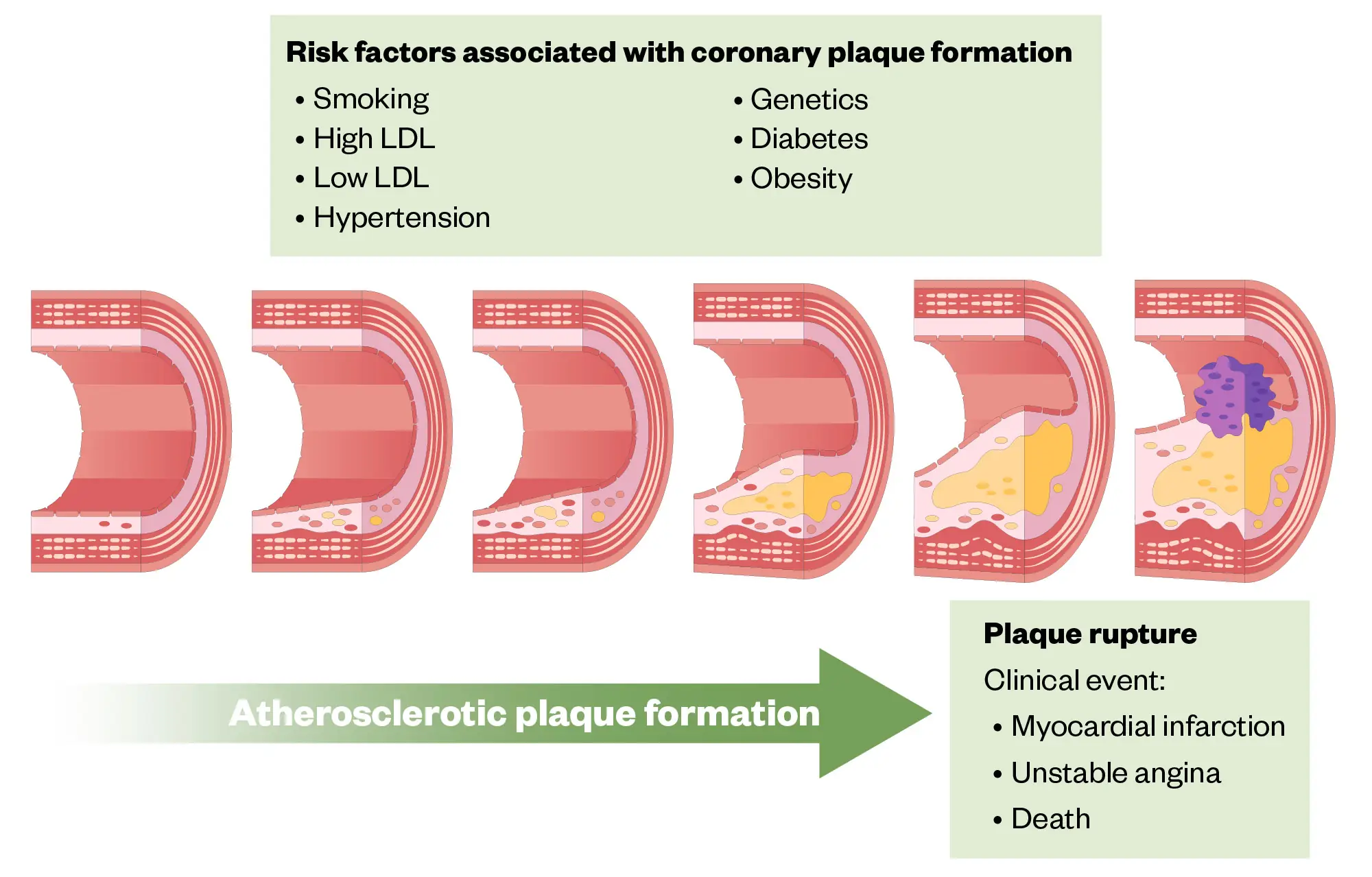 Illustration of atherosclerotic plaque formation and risk factors