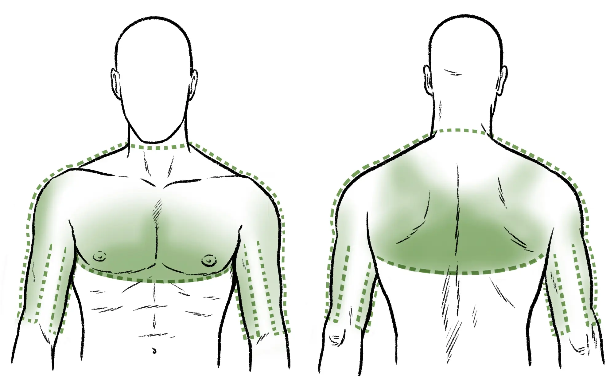 Illustration of where cardiac chest pain can occur on back and front of body