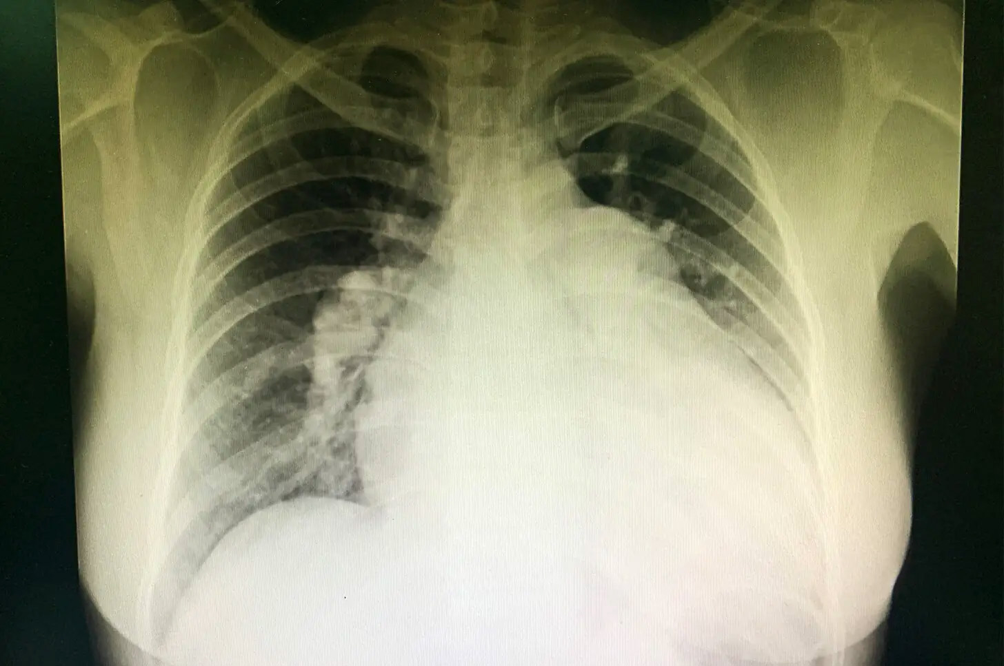 Chest x-ray of a woman