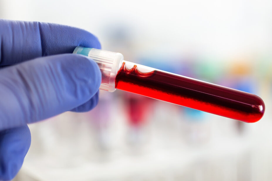 Blood sample in laboratory