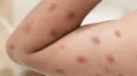 Mpox rashes appearing on a person's arm