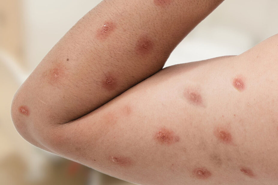 Mpox rashes appearing on a person's arm