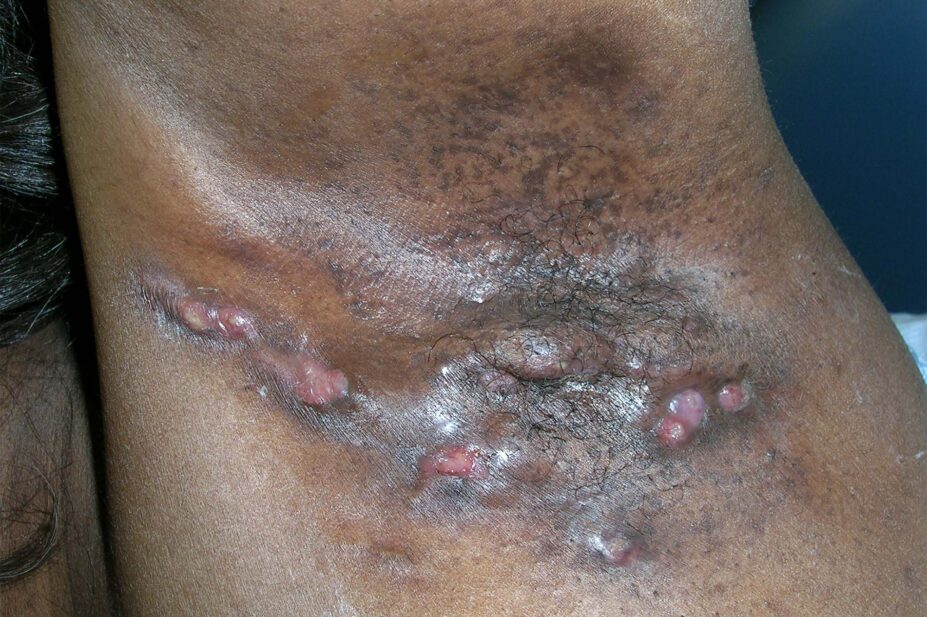 Photo of an armpit of someone with hidradenitis suppurativa