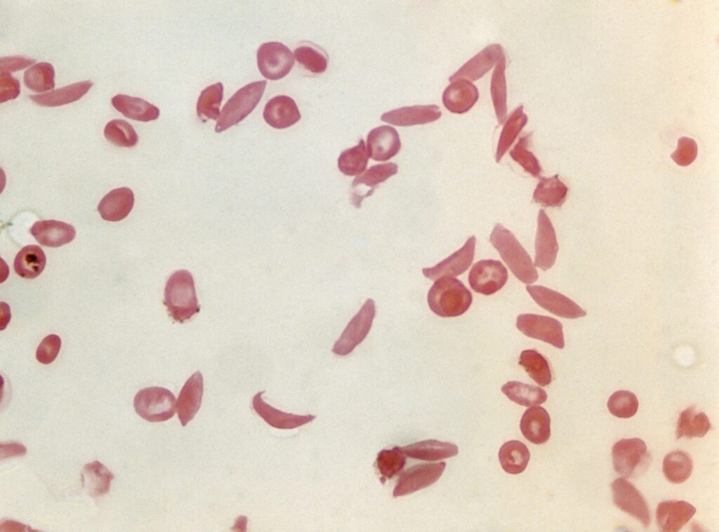 Light micrograph of normal red blood cells (erythrocytes, round) and red blood cells affected by sickle cell anaemia (crescent-shaped)