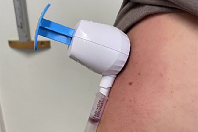 Microsampling: a patient-centred approach to therapeutic drug ...