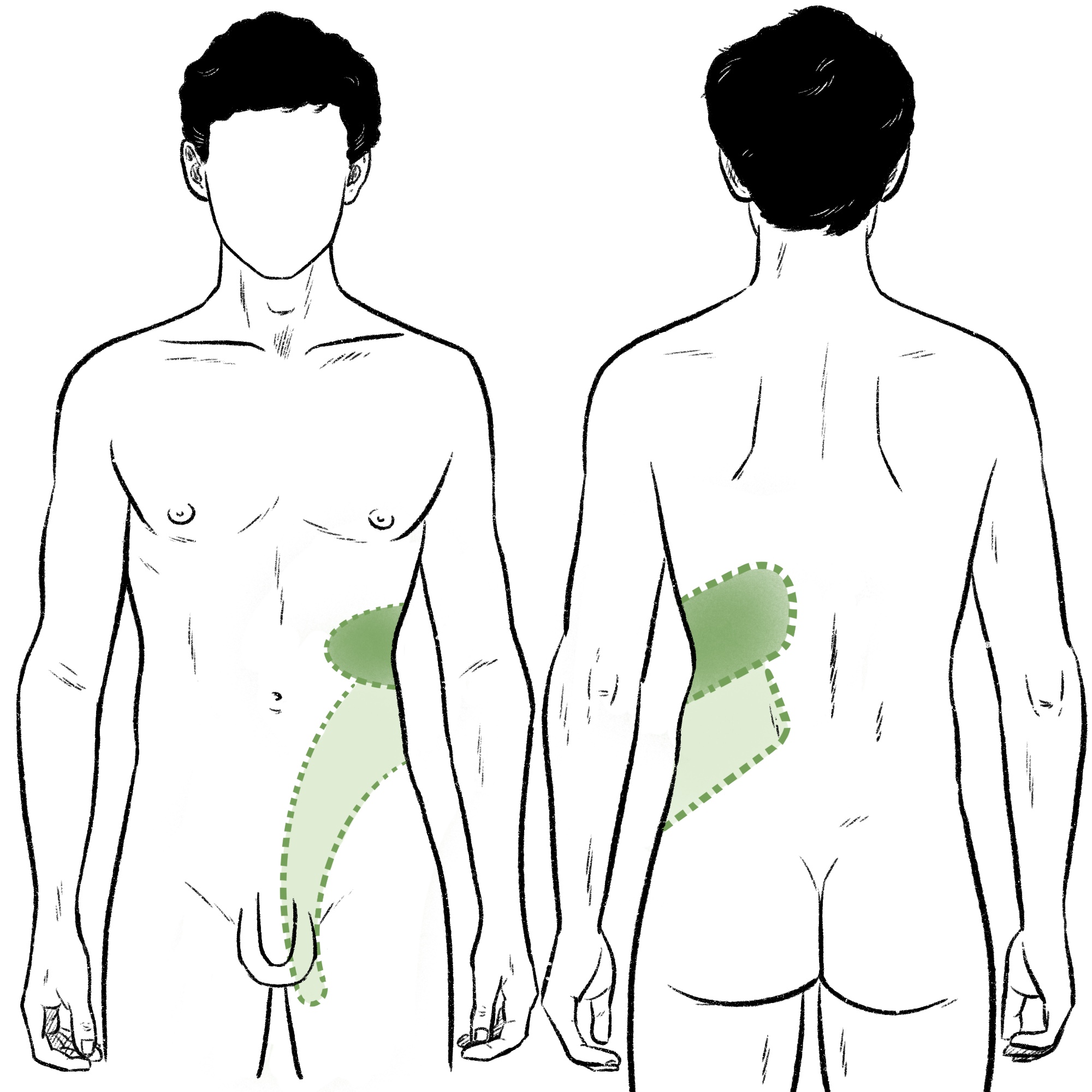 Illustration showing a darker swell of pain on the front of the left rib cage through to the back, and a lighter swell of pain from just below that to the top of the left thigh.