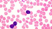 Light micrograph of lymphocytes in a human blood smear in a case of chronic lymphocytic leukaemia