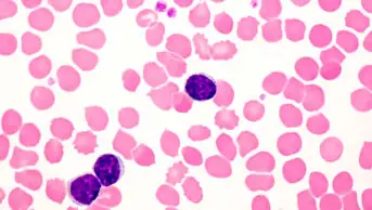 Light micrograph of lymphocytes in a human blood smear in a case of chronic lymphocytic leukaemia