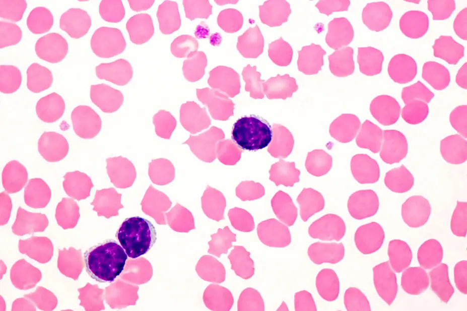 Light micrograph of lymphocytes in a human blood smear in a case of chronic lymphocytic leukaemia