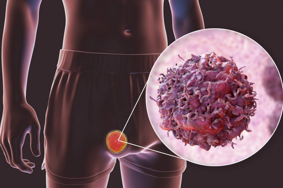 Computer illustration showing a malignant tumour in the testis and a close-up view of a testicular cancer cell