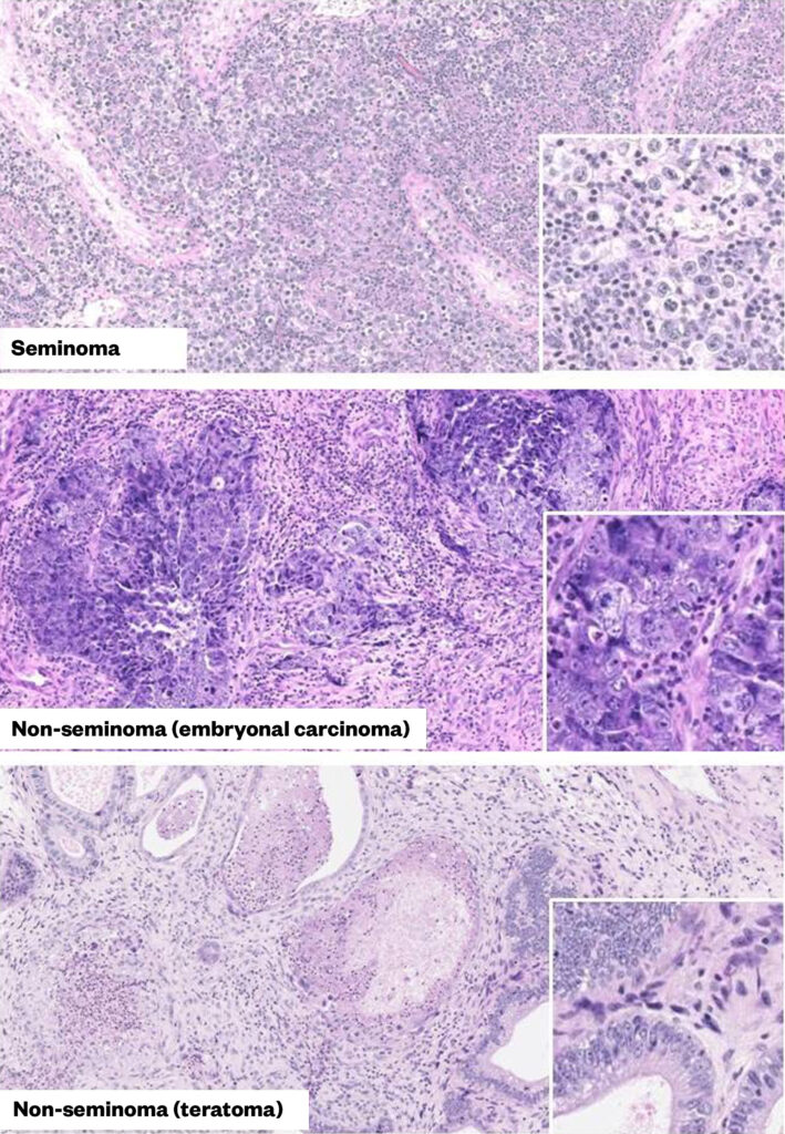 Histology of the main types of testicular germ cell tumours