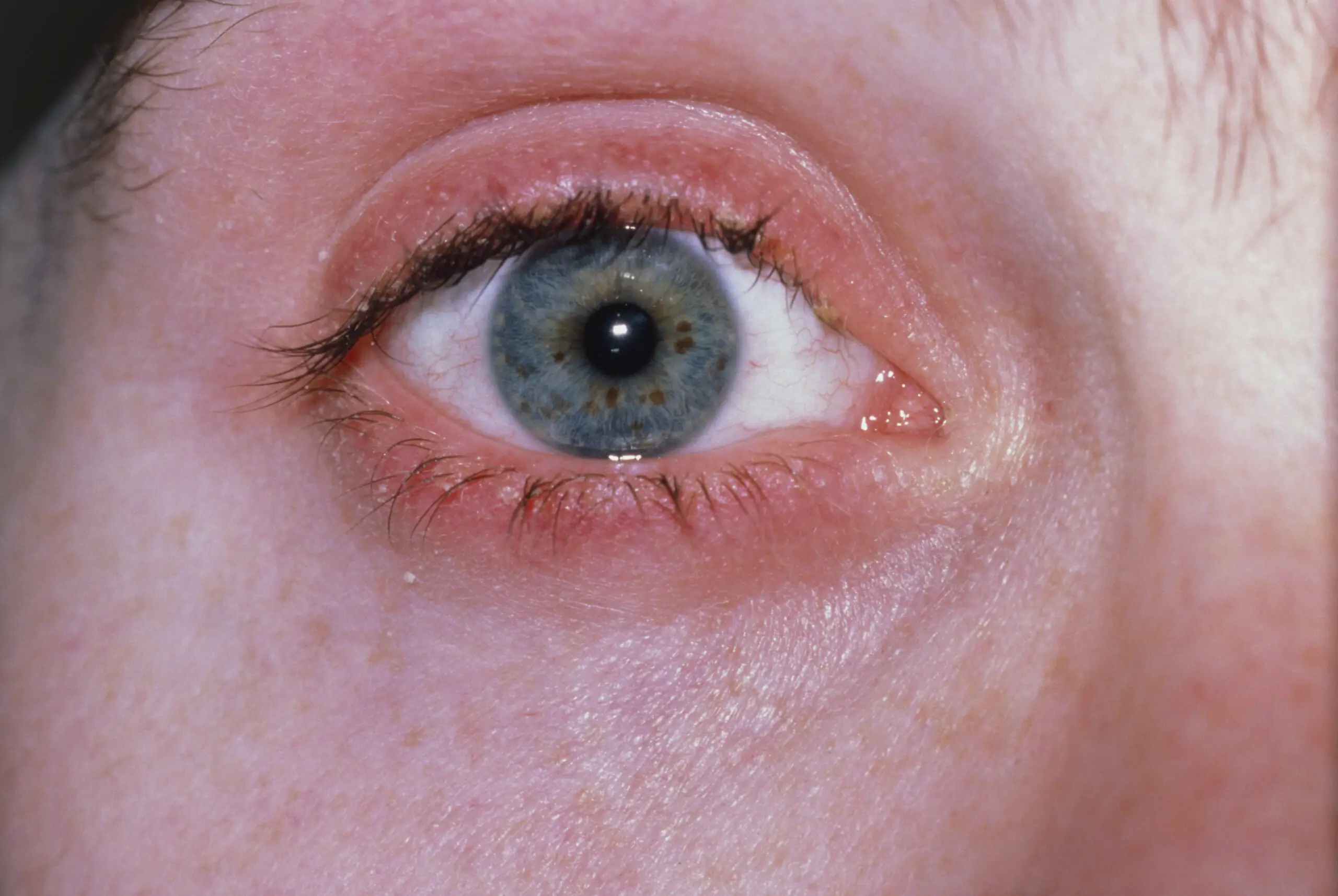 Macrophotograph of the eye showing blepharitis, the inflammation of the eyelids