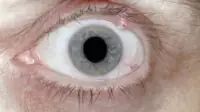 Stye bacterial eye infection on a person with blue eyes