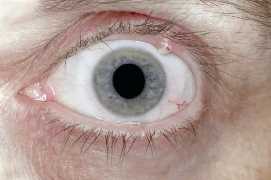 Stye bacterial eye infection on a person with blue eyes