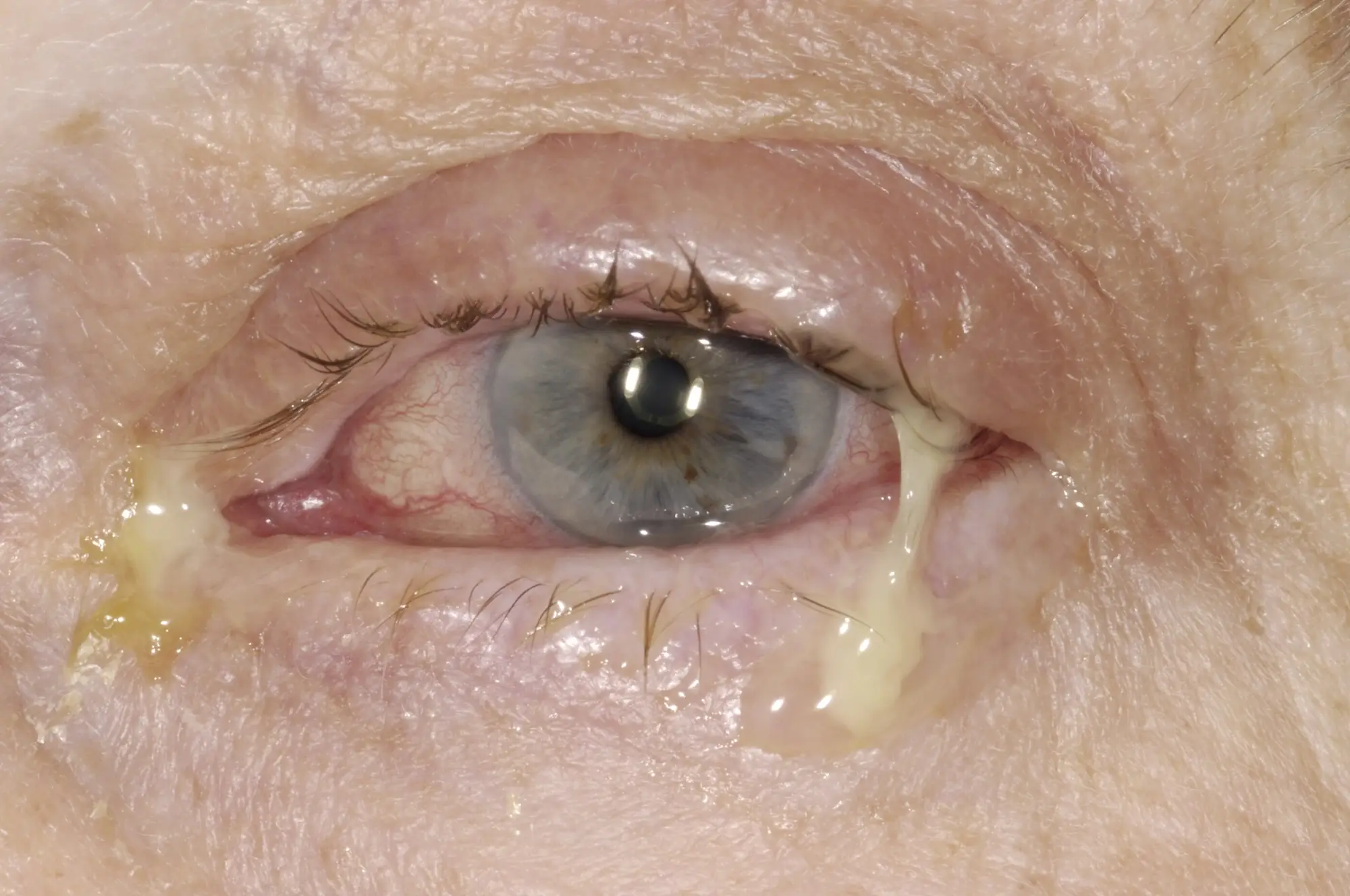 Purulent conjunctivitis