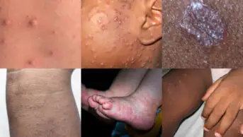 Collage of rashes from the article below