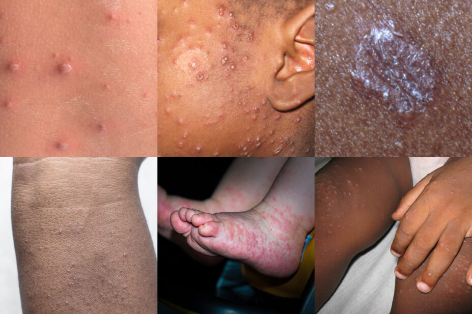 Collage of rashes from the article below