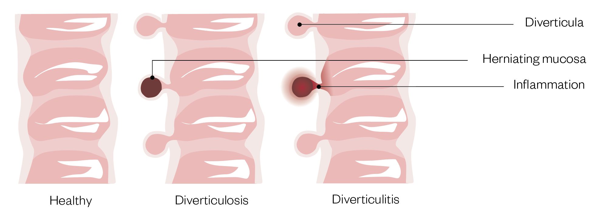 A diagram showing an intestine in healthy form and then with diverticulosis and again with diverticulitis, showing the herniating mucosa in the diverticulosis example, and an inflammation of the mucosa in the diverticulitis example