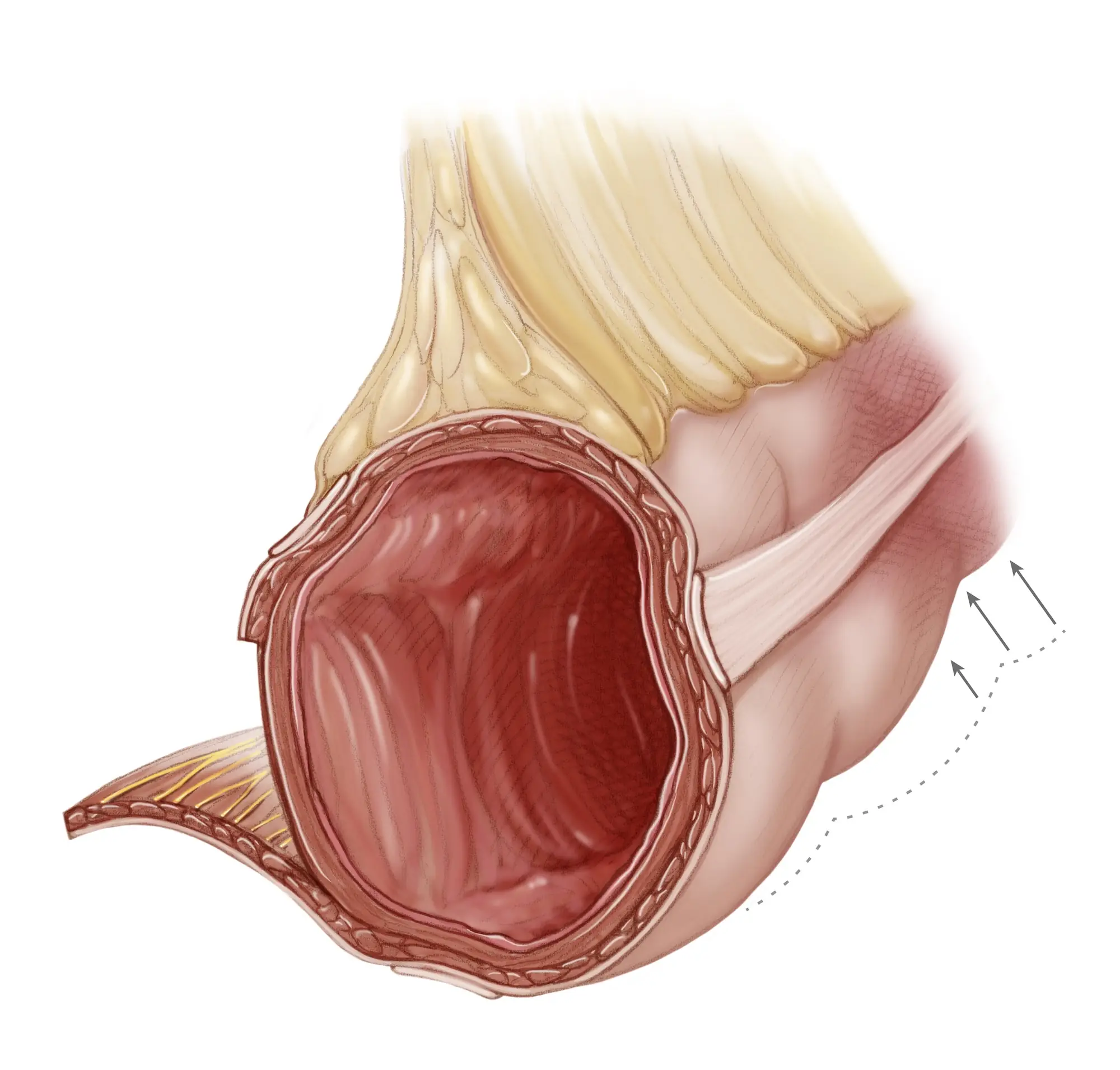 Medical illustration of an intestinal spasm