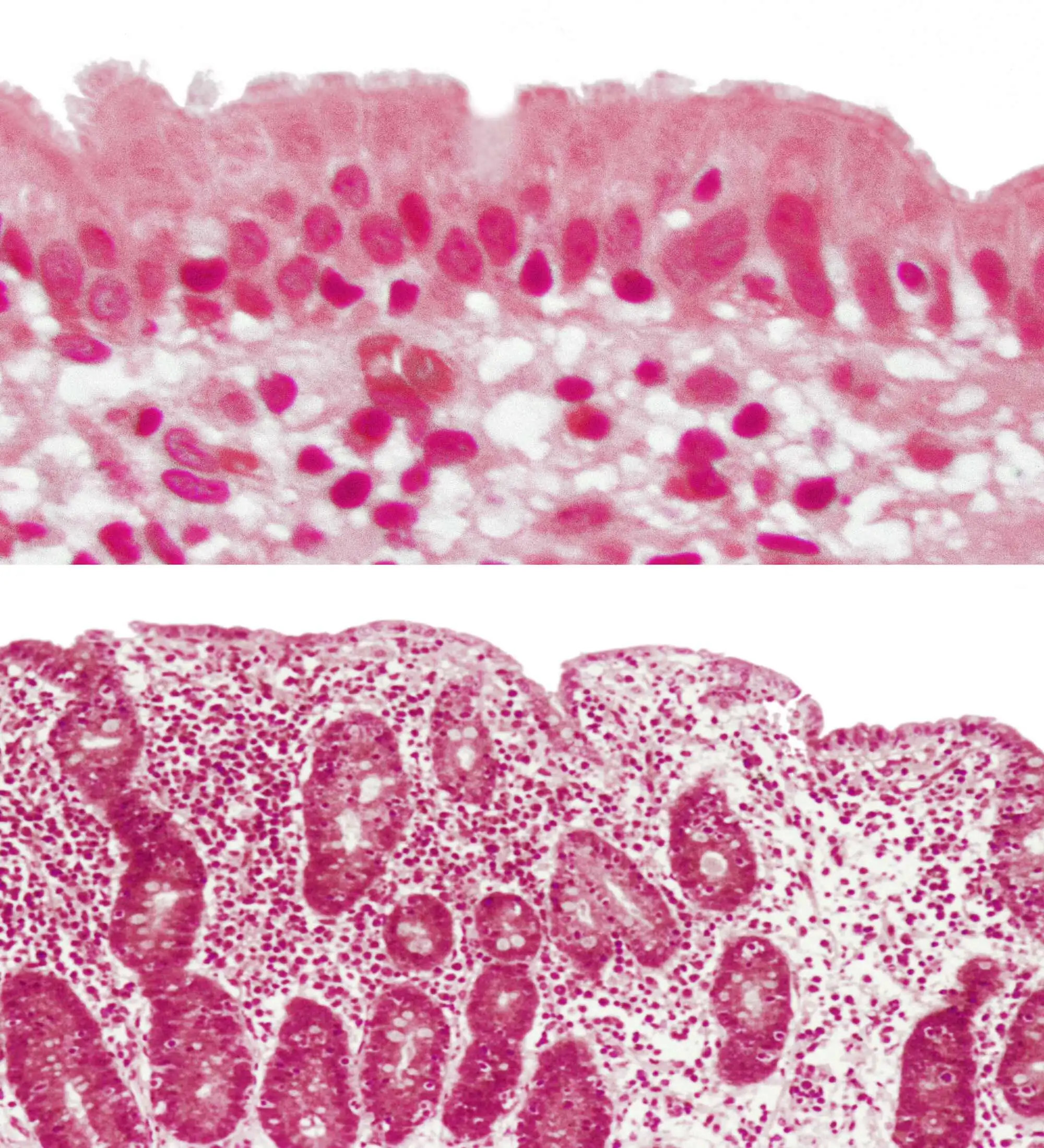 A composite of two light micrographs showing normal (top) and abnormal (bottom) jejunum.  The bottom image shows a section through a jejunum affected by celiac disease.