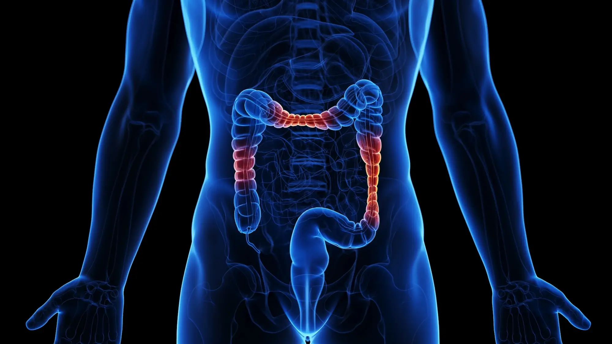 3d rendered medical illustration of inflammatory bowel disease