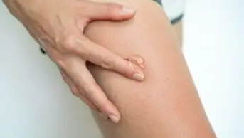 Close up of woman applying testosterone gel