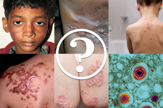 Del Conditis Test your knowledge of dermatological conditions - The Pharmaceutical ...