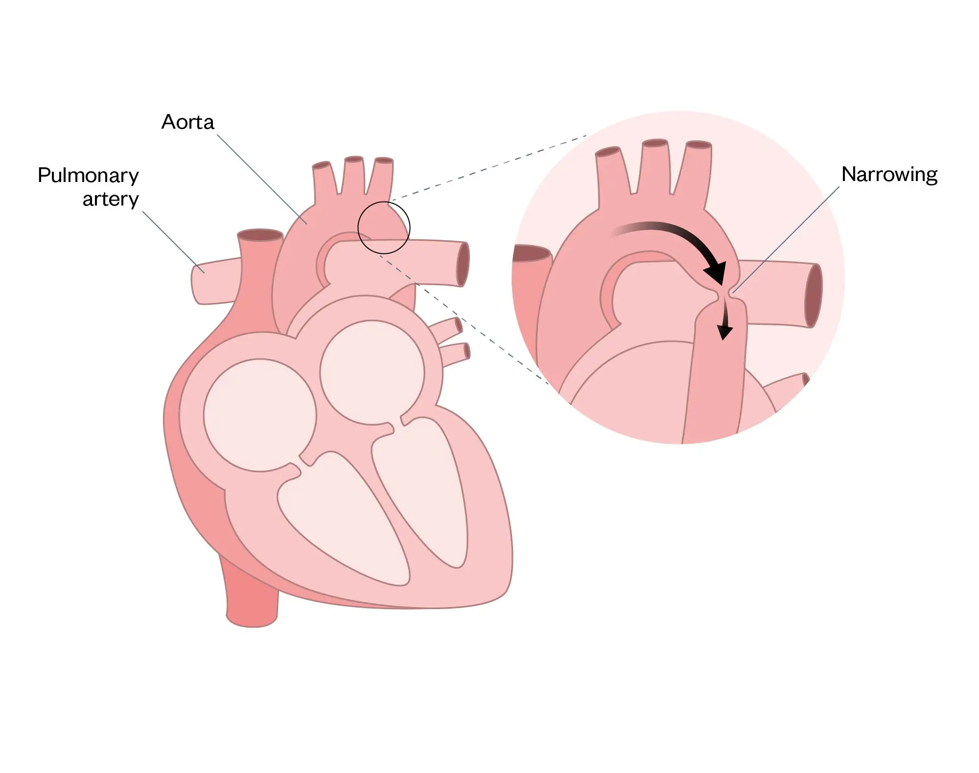 Congenital heart disease: an overview - The Pharmaceutical Journal