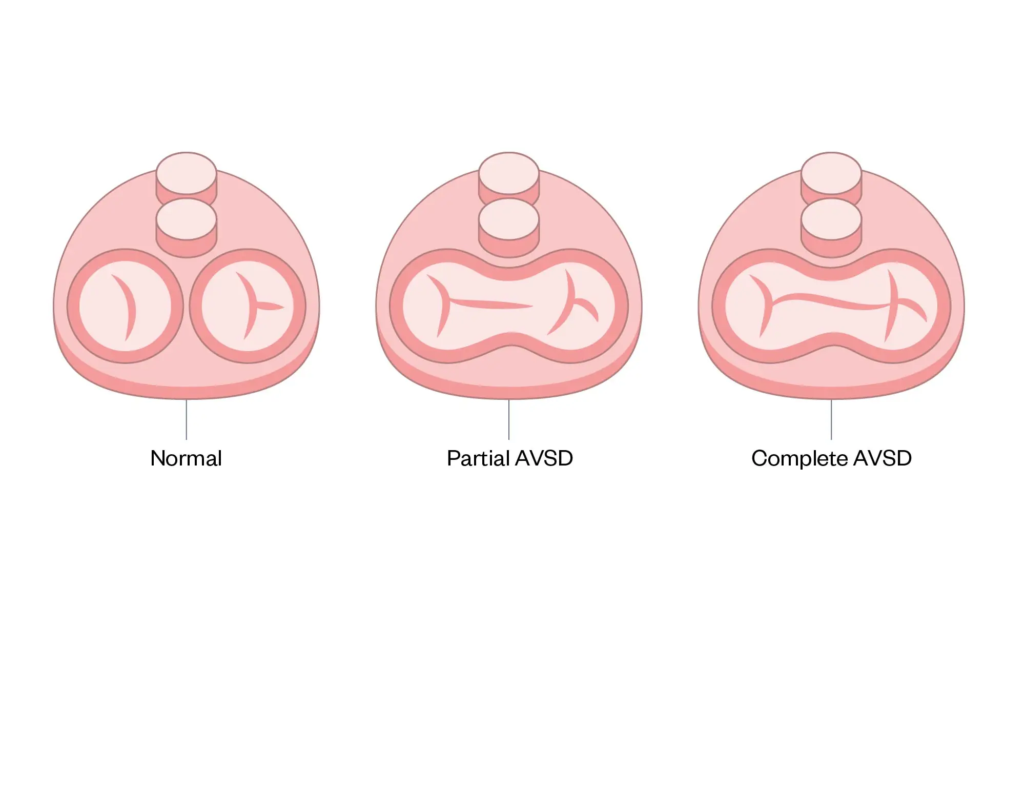 Avsd Wave Congenital heart disease: an overview - The Pharmaceutical Journal