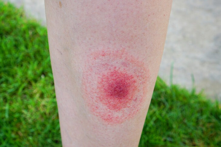 Test your knowledge of dermatological conditions - The Pharmaceutical ...
