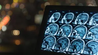 A CT scan of a brain