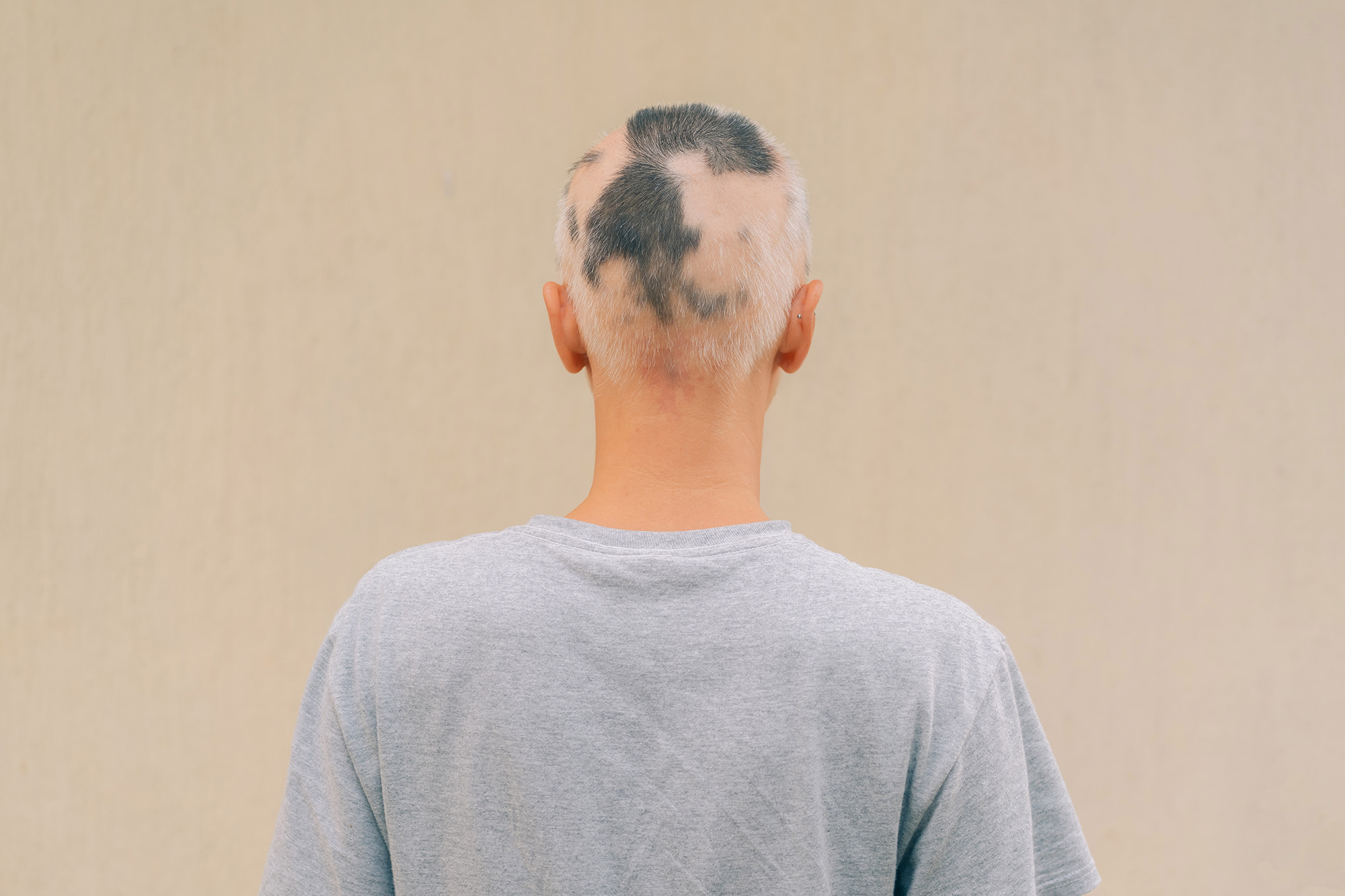 Alopecia areata: recognition, diagnosis and management - The Pharmaceutical  Journal