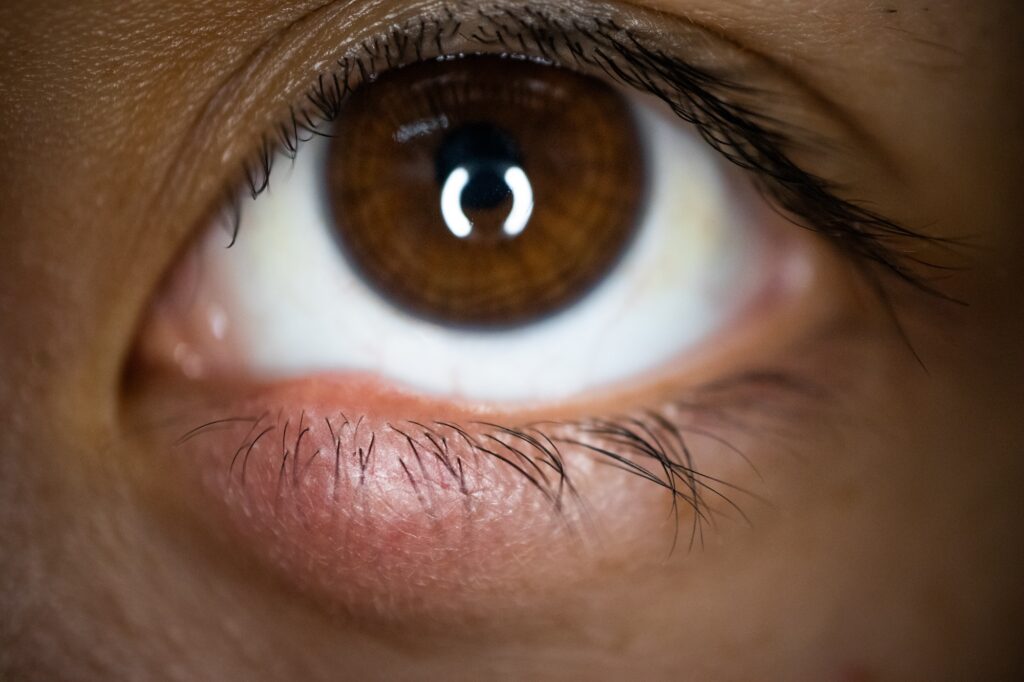 Inflammation of the sebaceous glands at the base of the lashes (Under the eyelids) with swelling, redness, heat and may have pain But not harmful to the eyes Can be treated with eye drop