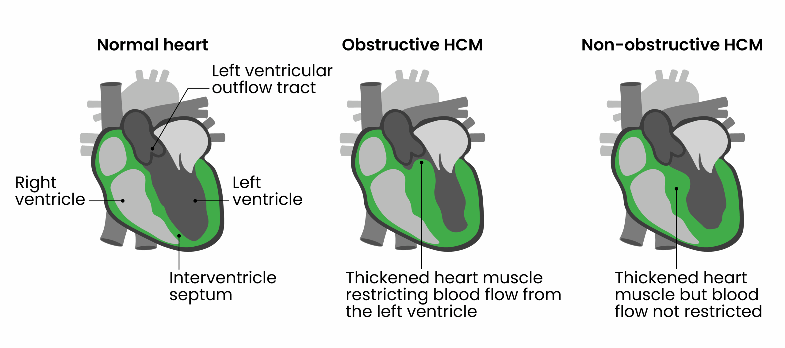 Figure shows normal heart vs Obstructive HCM where the thickened heart muscle blocks blood flow from the left ventricle, and Non-obstructive HCM where muscle is thickened but not totally blocking