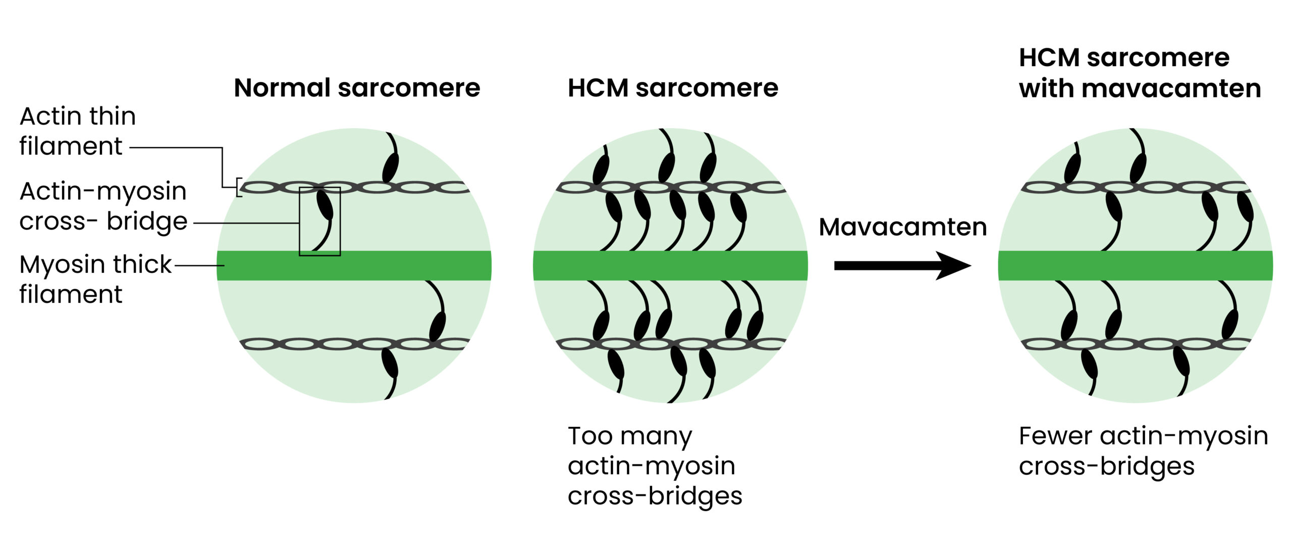 3 circles in green showing normal sarcomere (actin thin filament, actin-myosin cross-bridge, and myosin thick filament), HCM sarcomere (too many actin-myosin cross-bridges) and HCM sarcomere with mavacamten (fewer)