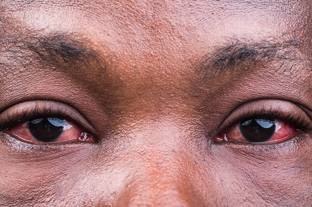 A close-up of a person with redness in the eyes