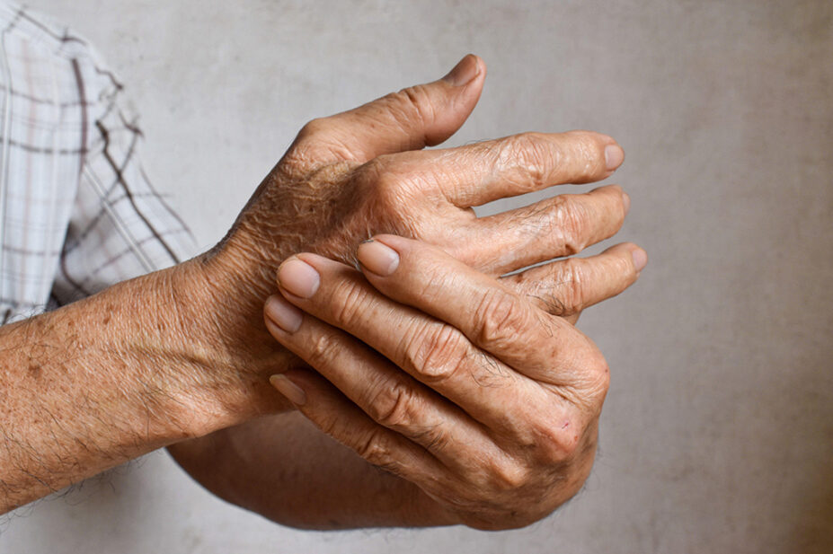 An older man with rheumatoid arthritis massages his hand