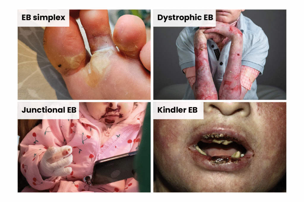 Four images showing the main types of EB. Top left shows EBS: blisters between the toes. The second shows DEB, severe wounds on arms. Third shows JEB, hands bound in bandages and wounds around the nose and mouth. Last shows KEB, wounds around the mouth and on the lips/gums.