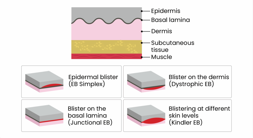 Top shows a cross section of the skin from the epidermis to the muscle. Beneath are the four types of EB showing cross sections of skin and where the blister forms between the layers