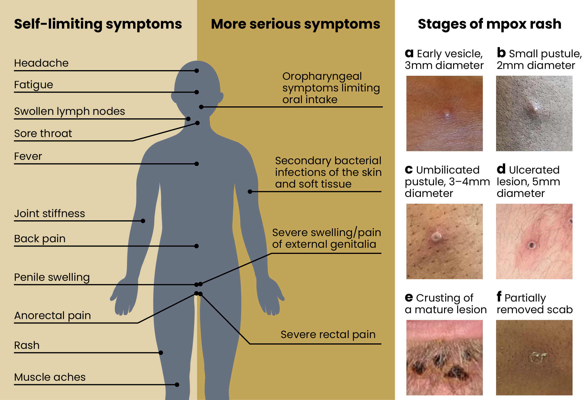 Figure showing self-limiting symptoms and serious symptoms on the body. There are also pictures of 6 stages of mpox rash 