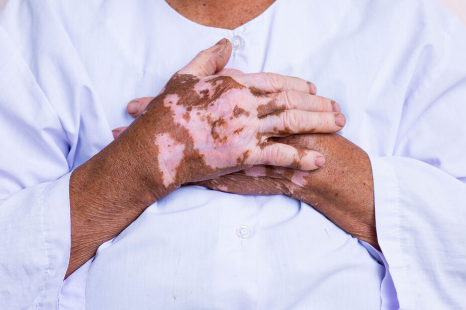 Vitiligo on the hands of old person, who clasps their hands over their chest