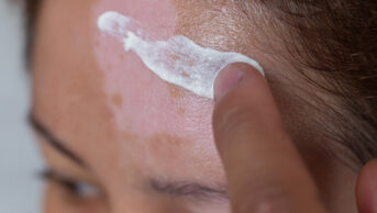 A woman with vitiligo applies cream to her forehead