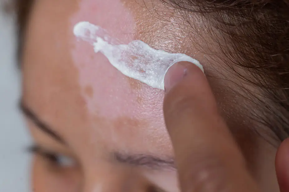 A woman with vitiligo applies cream to her forehead